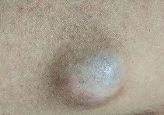 脚にできた粉瘤(アテローム)を上から撮影