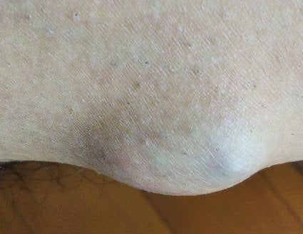 脚にできた粉瘤(アテローム)を横から撮影