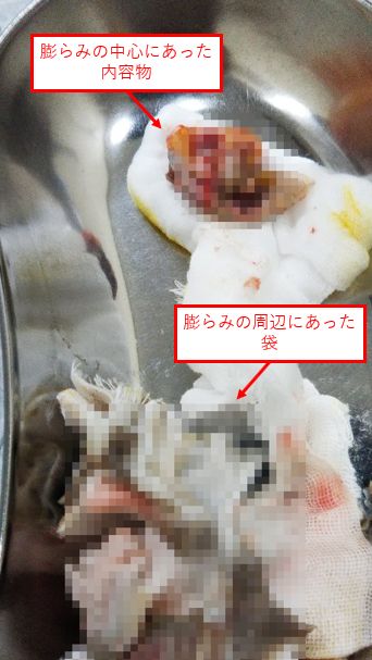 脚にできた粉瘤(アテローム)を切開して取り出した内容物