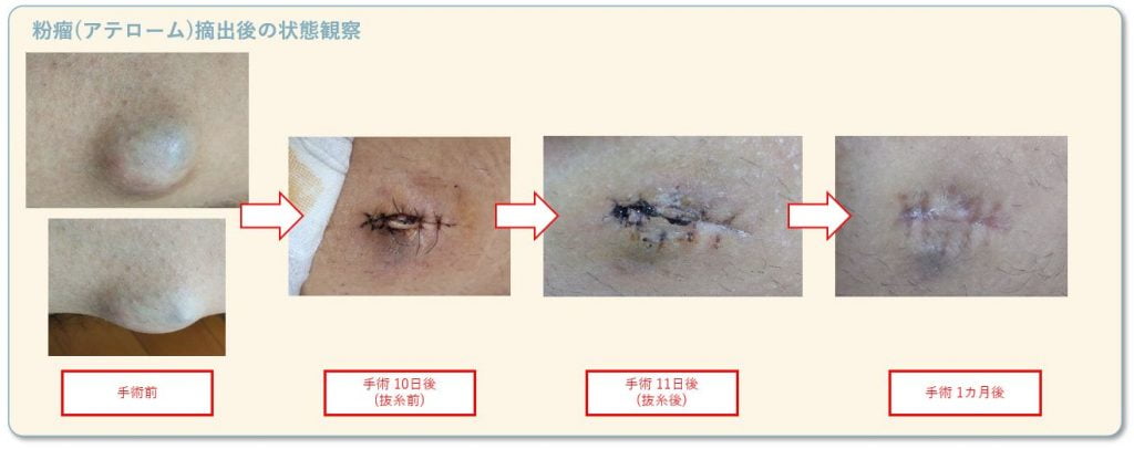 粉瘤(アテローム)摘出部の状態変化